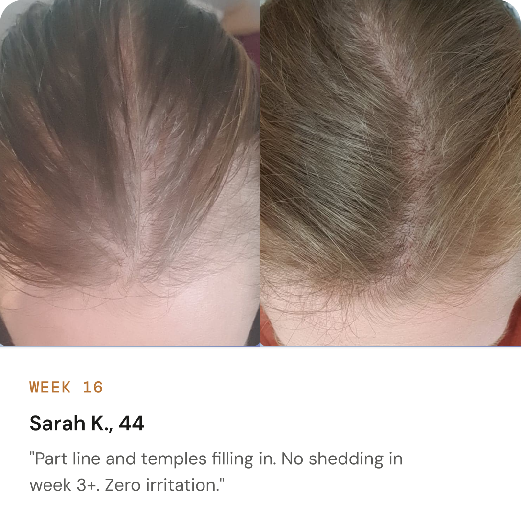 AHK-Cu before and after: hairline and temples, verified customer photo